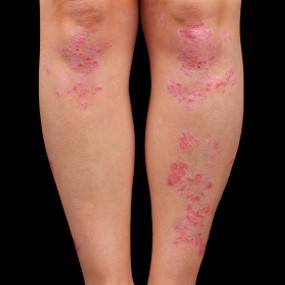 Psoriasis-placa