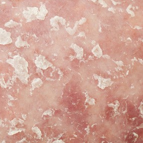 psoriasis-eritrodermica