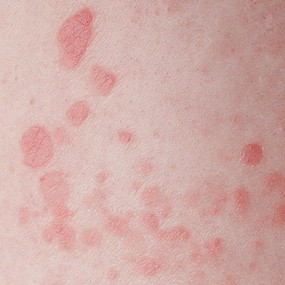 psoriasis-guttata