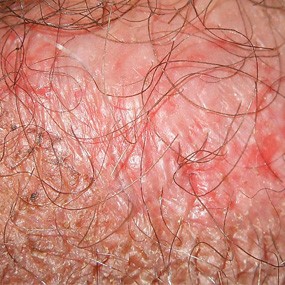 psoriasis-inversa