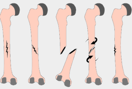 Tipos de Fracturas (Guía Ilustrada)